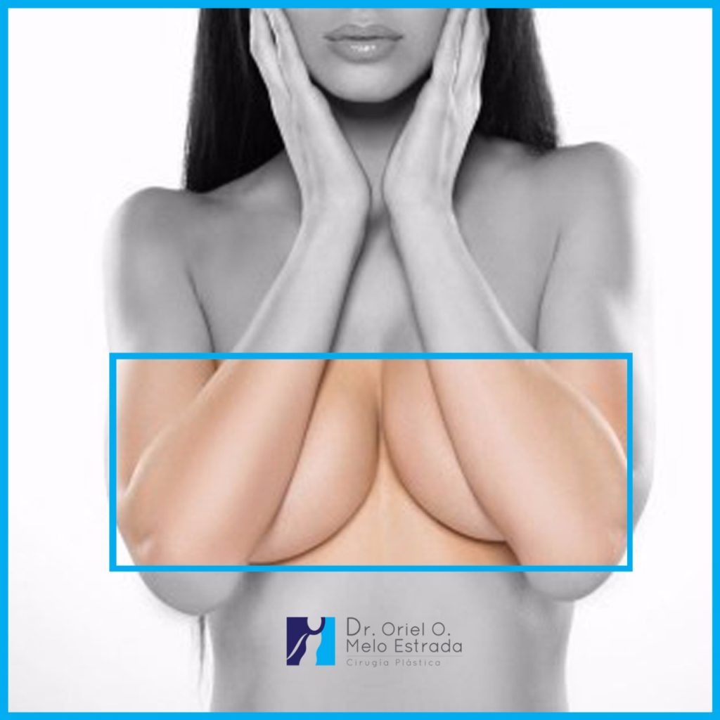 Busto cirugía de busto