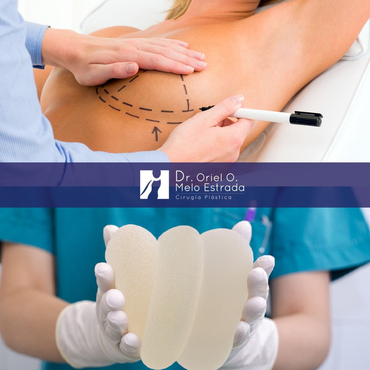 Aumento Mamario Senos